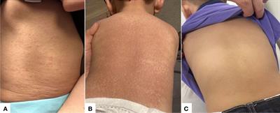 Case Report: Methotrexate and hydroxychloroquine in combination for the treatment of NOD2-mutation-associated Blau syndrome